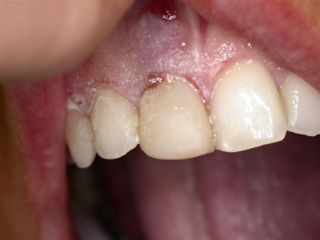 Endodonzia: Un centrale con radice perforata.