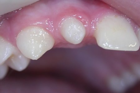 Dens in Dente o meglio invaginazione dentale